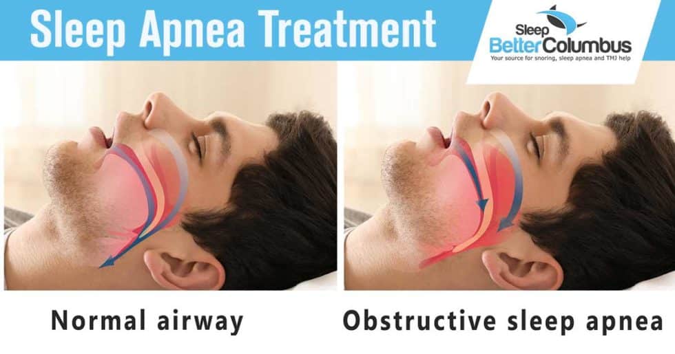 Galloway Sleep Apnea Treatment | Sleep Apnea Treatment in Galloway